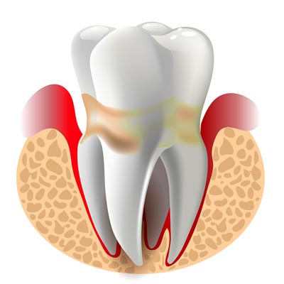 tooth illustration with gum disease